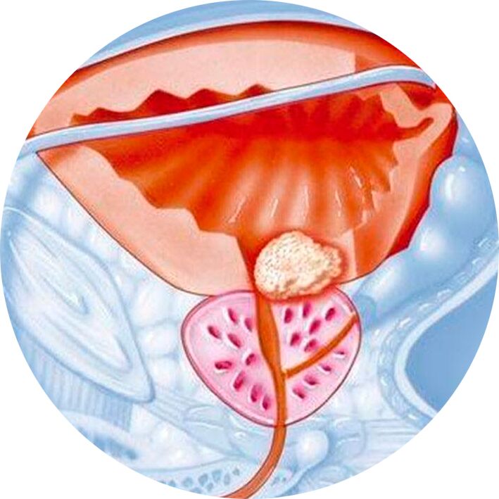 Adenoma prostate